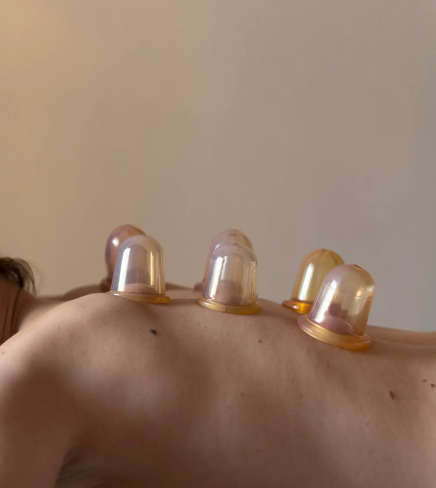 Six cupping glasses placed on a client's back during her Fascia Stretch Body Cupping Treatment experience at Pause Spa